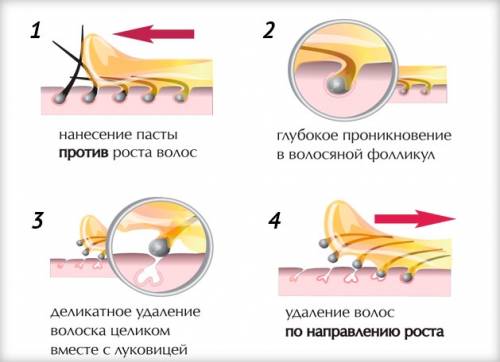 Шугаринг (сахарная депиляция)